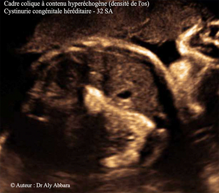 Colon (cadre colique) hyper-échogène - cystinurie hériditaire