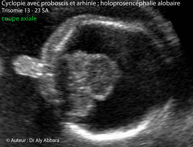 Cyclopie - Holoprosencéphalie - trisomie 13 - 23 SA