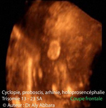 Cyclopie - coupe frontale - 23 SA - Trisomie 13
