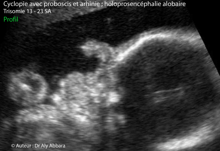 Cyclopie - coupe frontale - 23 SA - Trisomie 13
