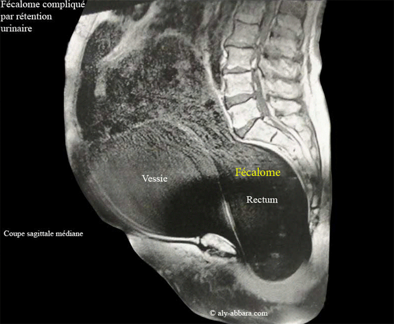 Fécalome provoquant une dysurie (rétention urinaire) chez patiente très âgée
