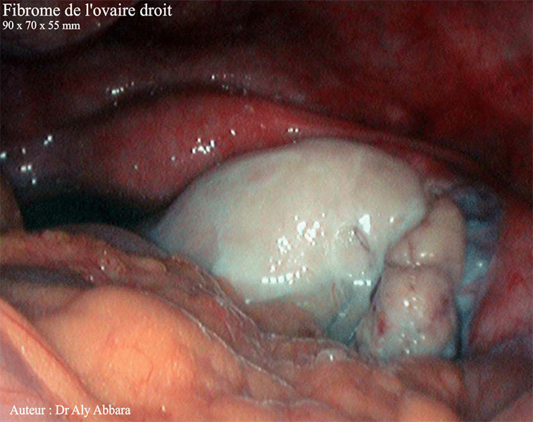 Fibrome de l'ovaire droit avec ascite localisée dans le pelvis