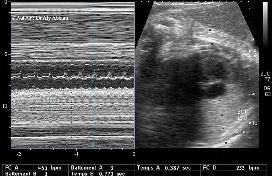 Flutter auriculo-ventriculaire