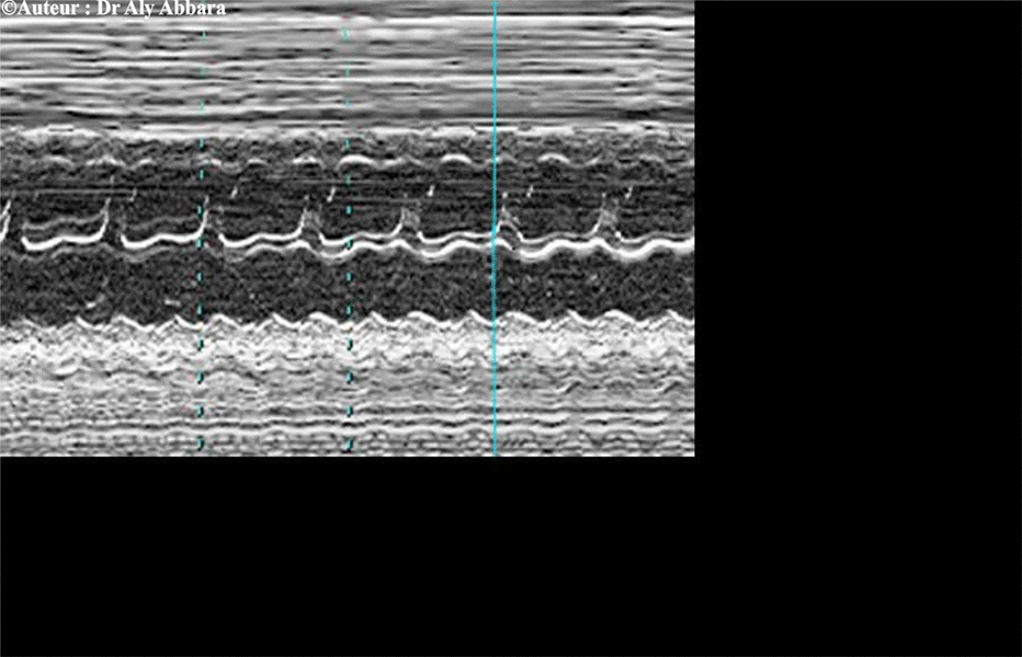 Flutter auriculo-ventriculaire - détails