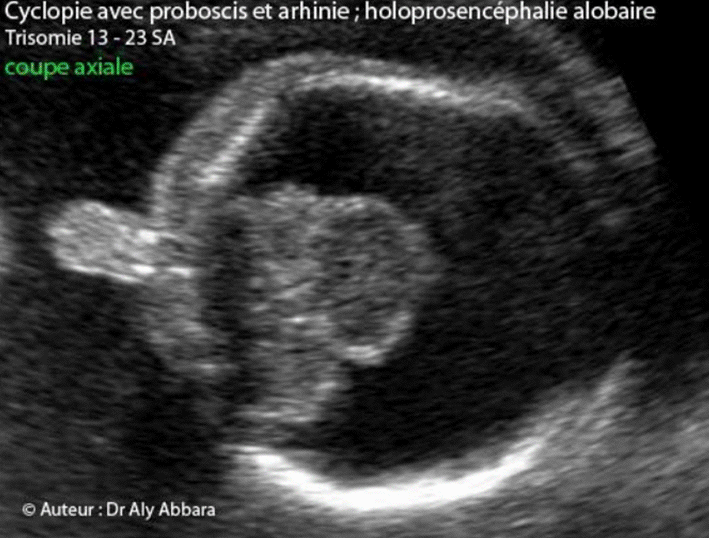 Holoprosencéphalie alobaire - Probosis - Arhinie - Trisomie 13 - 23 SA
