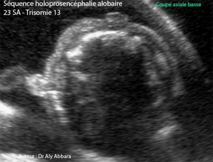 Hypoplasie de l'oreille externe dans un contexte d'holoprosencéphalie alobaire - Trisomie 13 - 23 SA