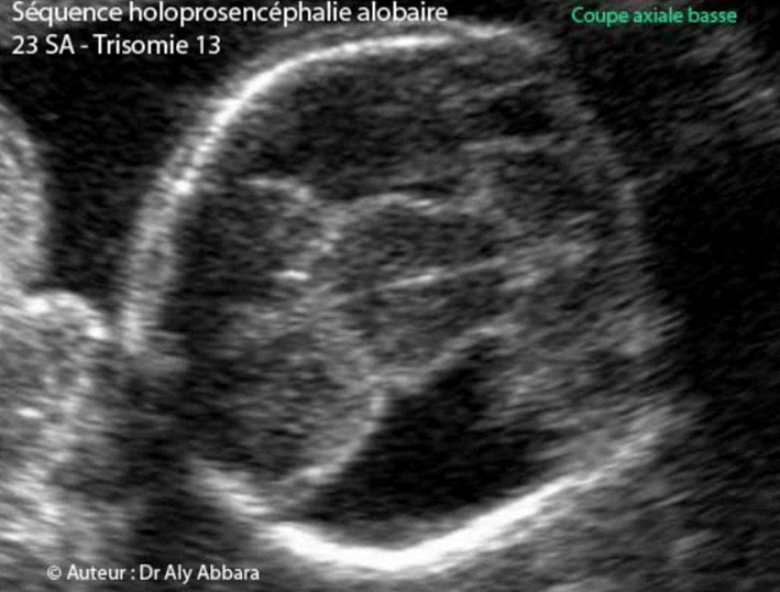 Holoprosencéphalie- - Fusion des thalami - absence du troisième ventriculae - Trisomie 13 - 23 SA