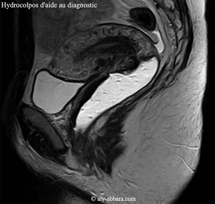 Hydrocolpos-construit-S-IRM