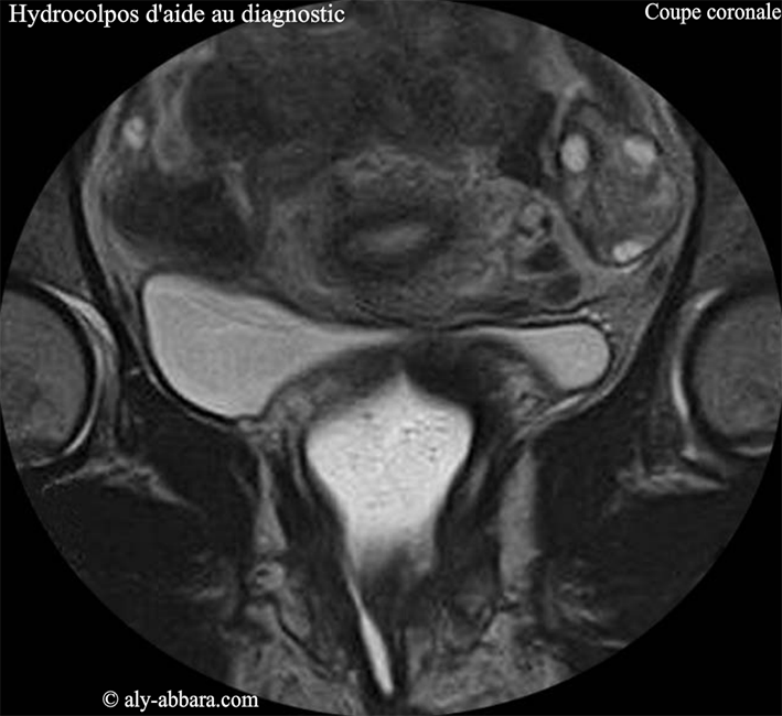 Hydrocolpos d'aide au diagnostic - IRM pelvienne