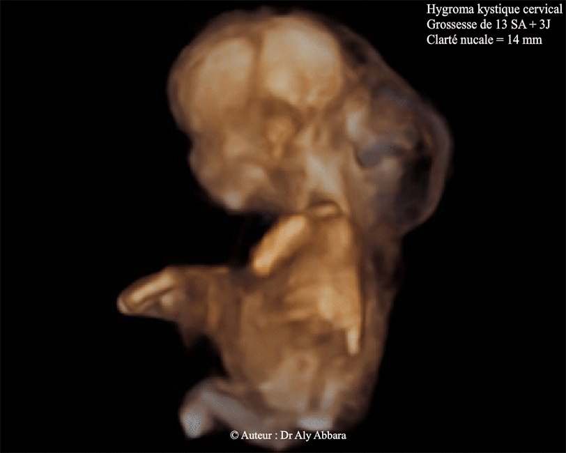 Hygrpma cervical kystique - Foetus âgé de 13 SA et 4 jours - Echographie 3D