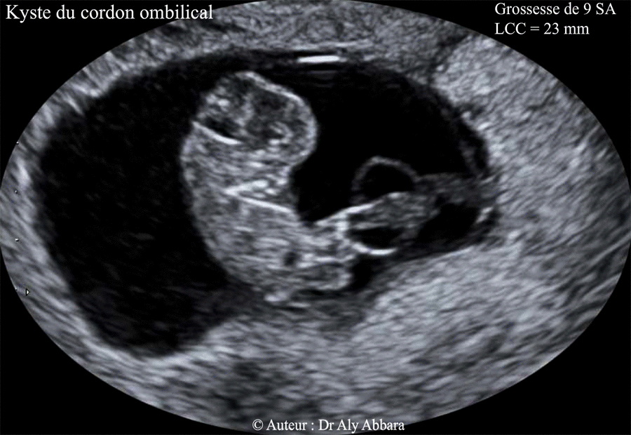 Kyste du cordon ombilical - Embryon de 9 SA