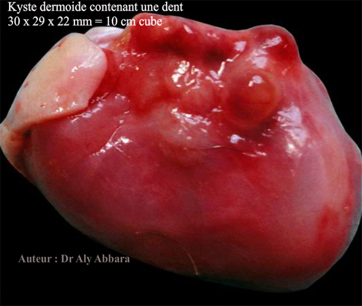 Kyste dermoïde de l'ovaire contenant une dent - Images cliniques