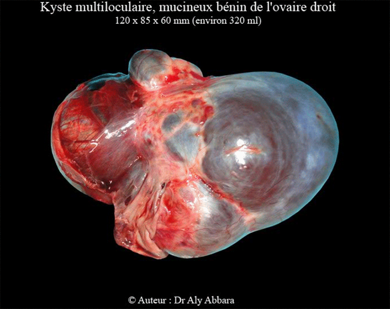 Kyste mucineux multiloculaire bénin de l'ovaire - Images cliniques