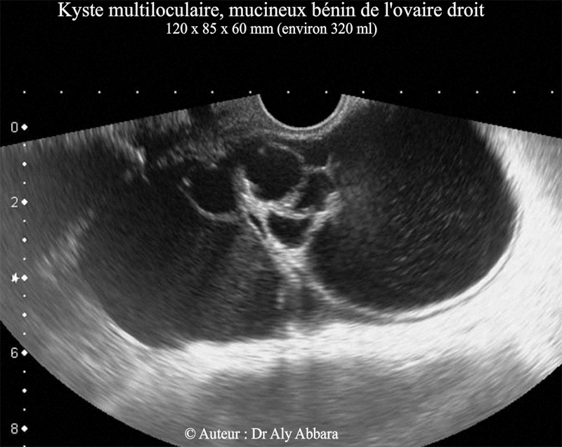 Kyste mucineux multiloculaire bénin de l'ovaire droit -  Images échographiques