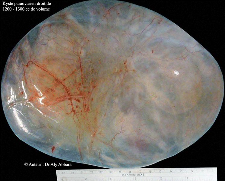 Volumineux kyste para-ovarien de 1230 cc de capacité -Image clinique