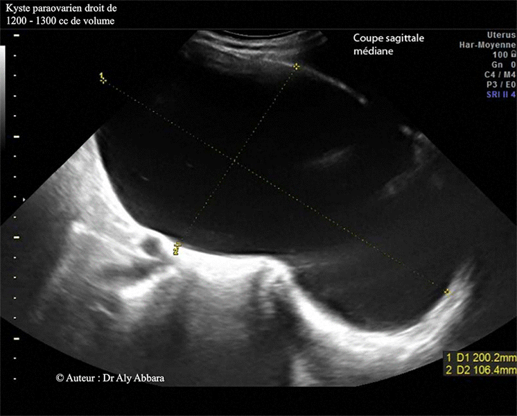 Kyste paraovarien de 1230 mm de volume - Images échographique et cliniques