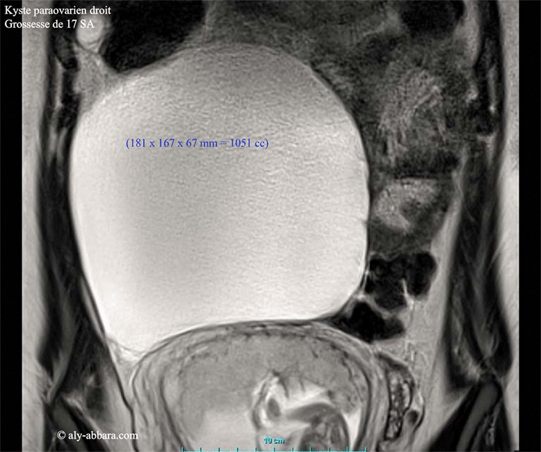 Kyste paraovarien droit chez une femme enceinte de 17 SA - IRM