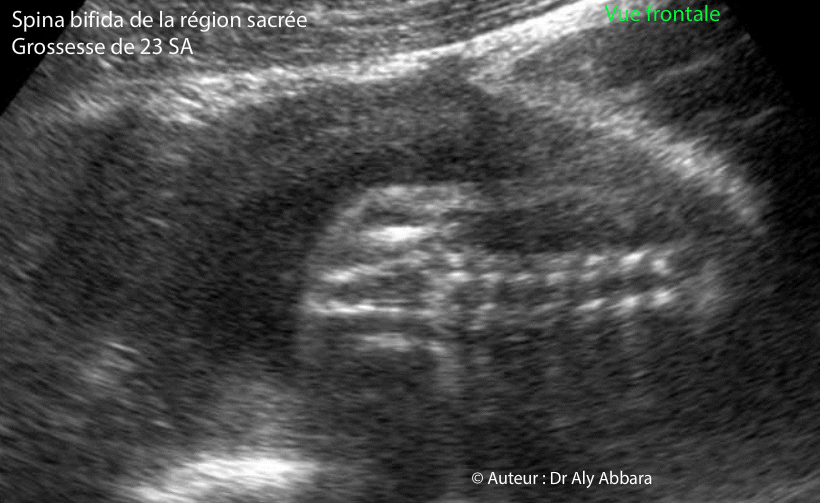 Spina bifida (vue frontale) - 23 SA