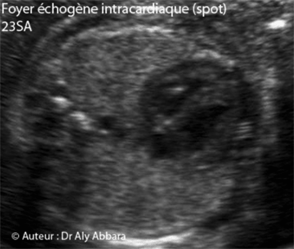 Coeur foetal - Spot intra-cardiaque - 23 SA