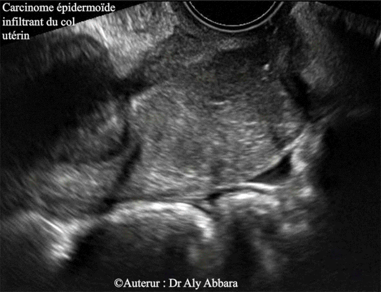 Carcinome épidermoïde infiltrant du col utérin