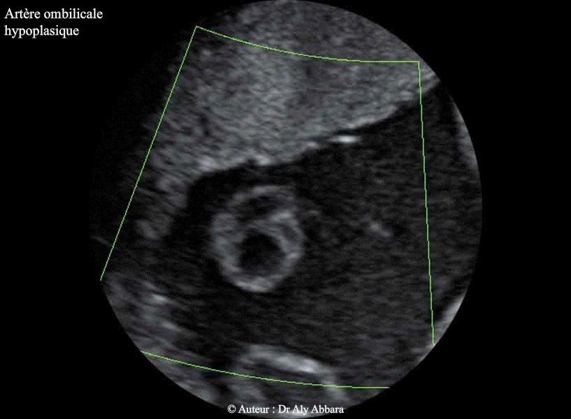 Cordon ombilical - Artère ombilicale hypoplasique