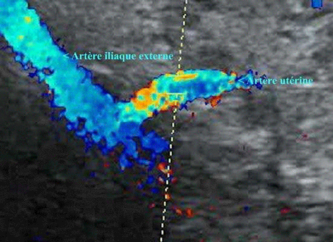 Artère utérine - Pulsatilité