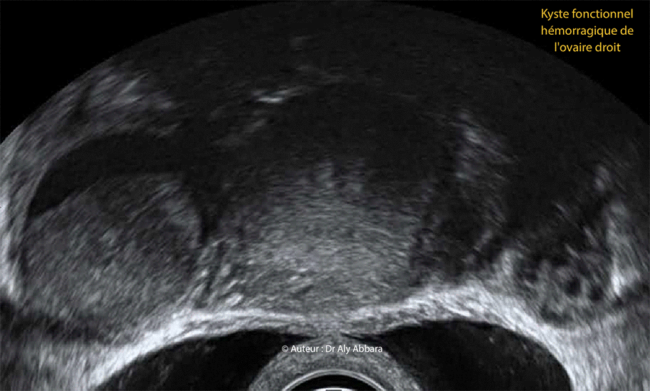 Kyste ovarien droi fonctionnel et hémorragique