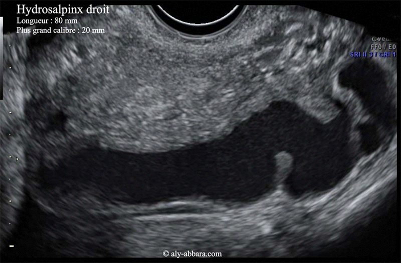 Hydrosalpinx droit