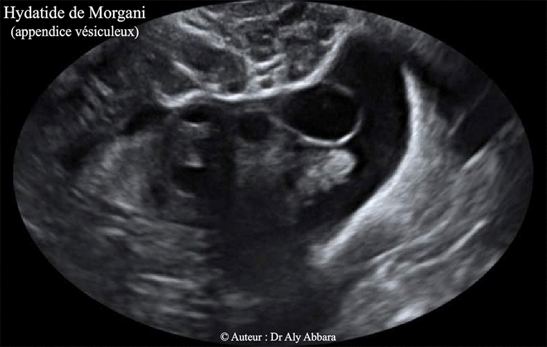 Kyste hydatide de Morgani