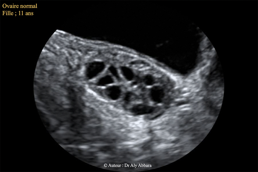 L'aspect échographique d'un ovaire normal chez une fille de 11 ans