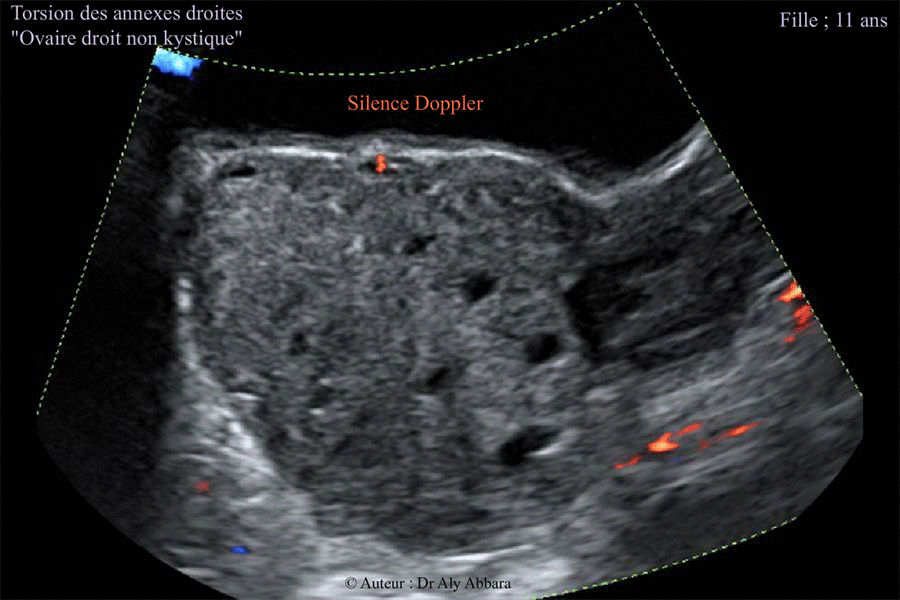 Torsion des annexes utérines droites chez une fille de 11 ans - Silence Doppler sur l'échographie