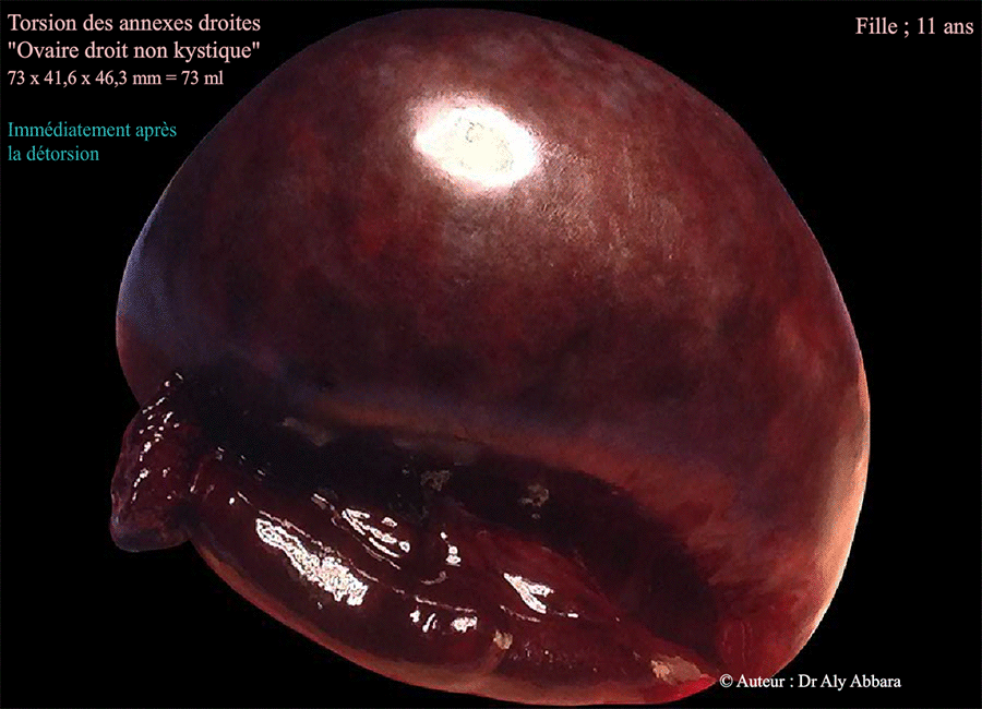 Torsion nécrosante des annexes droites chez une fille de 11 ans - Images cliniques immédiatement et 15 minutes après la détorsion
