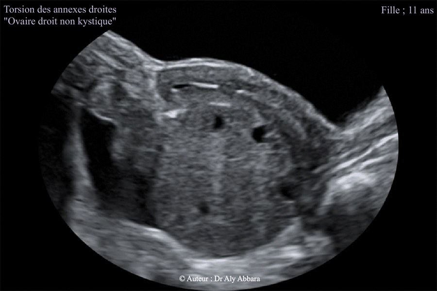 Torsion des annexes droites chez une fille de 11 ans - Aspect échographique de l'utérus et de l'ovaire droit