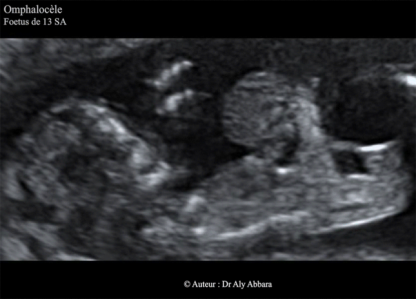 Omphalocèle à 13 SA - détails en 2D