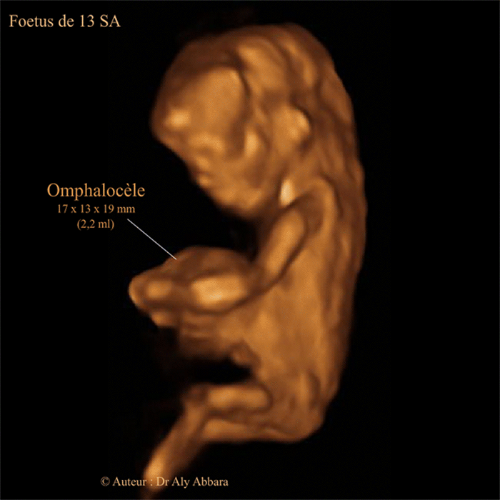 Omphalocèle à 13 SA - Image échographique en 3D