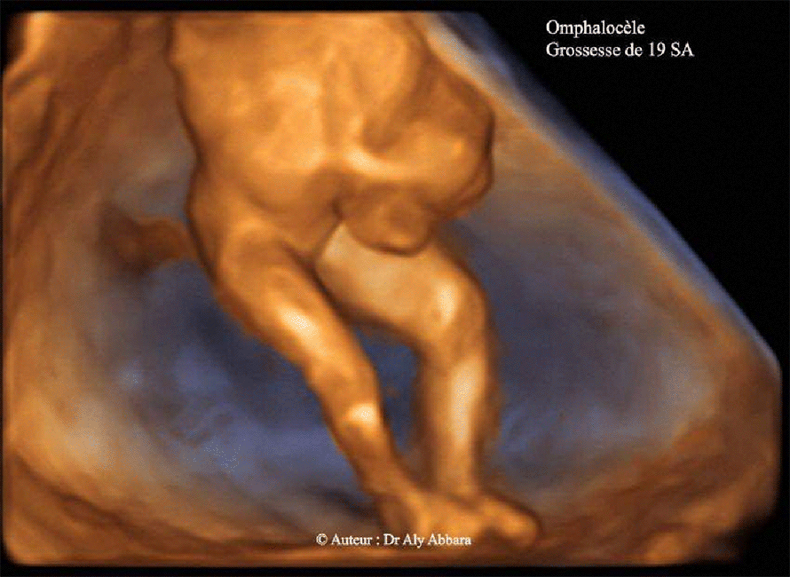 Omphalocèle - 19 SA contenant une partie des anses grêles et une composante kystique