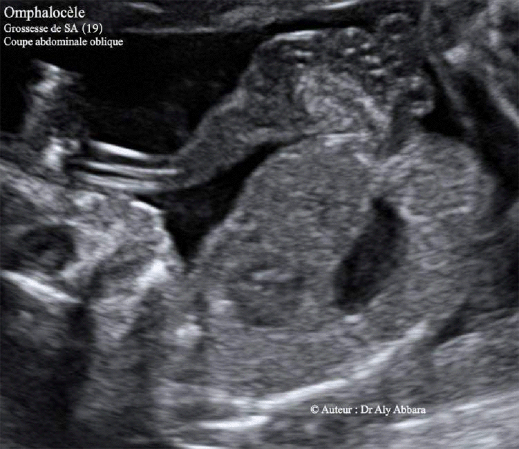 Omphalocèle - 19 SA contenant une partie des anses grêles et une composante kystique
