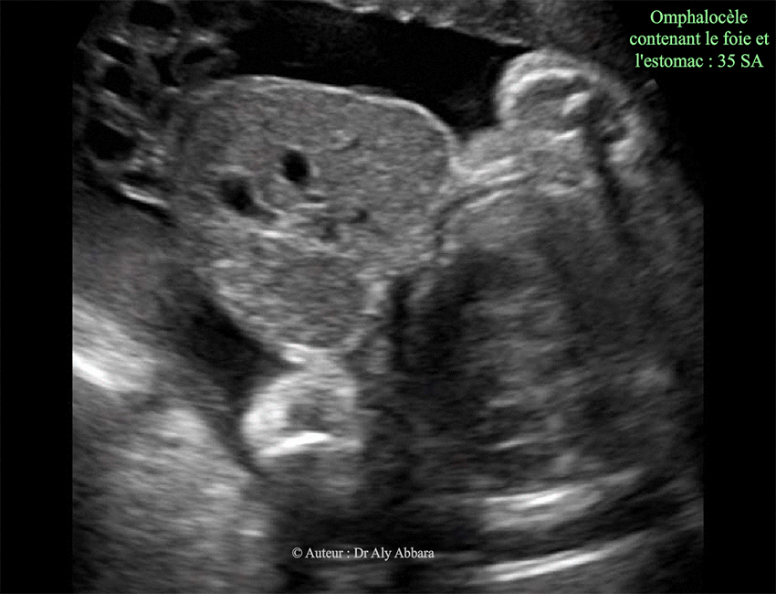 Omphalocèle à 35 SA contenant la totalité du foie