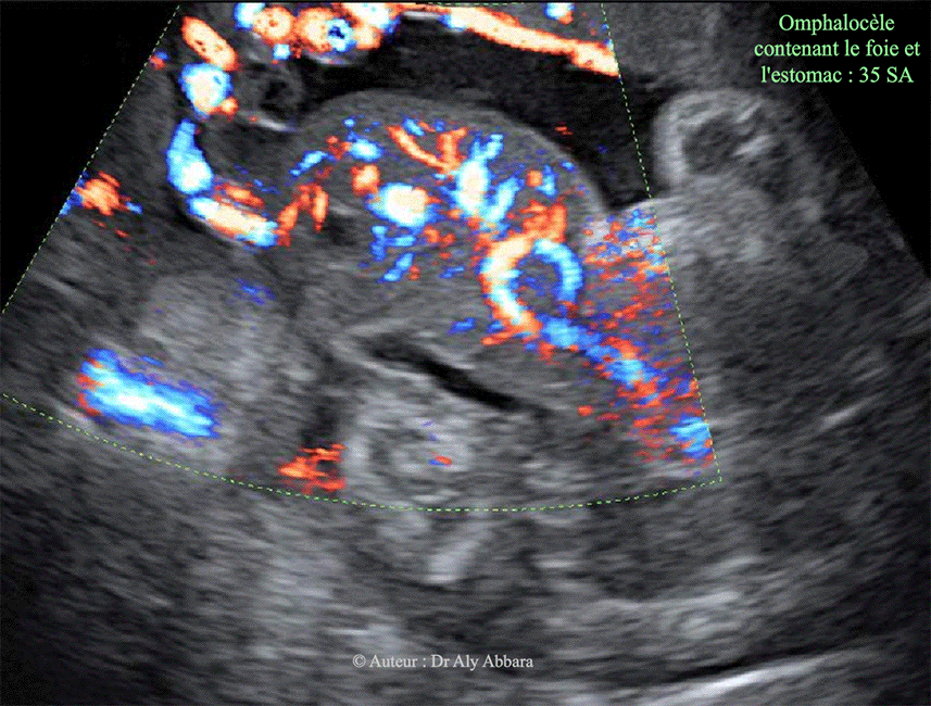 Omphalocèle volumineuse contenant le foie - Doppler - 35 SA