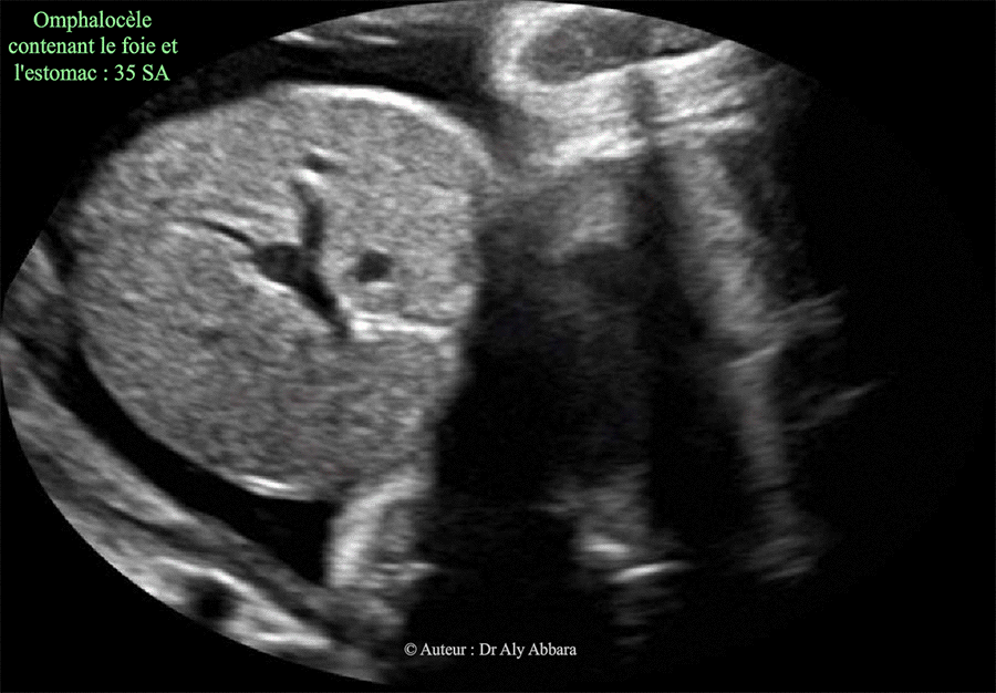 Omphalocèle volumineuse contenant le foie - 35 SA
