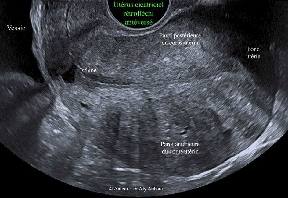 Utérus cicatriciel rétrofléchi antéversé