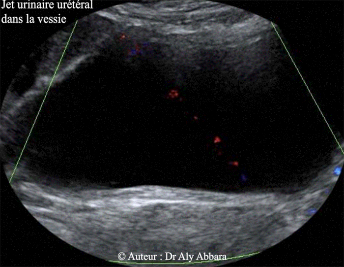 Coupe transvese sur la vessie mettant en évidence le jet urinaire urétéral dans la vessie grâce au Doppler couleur