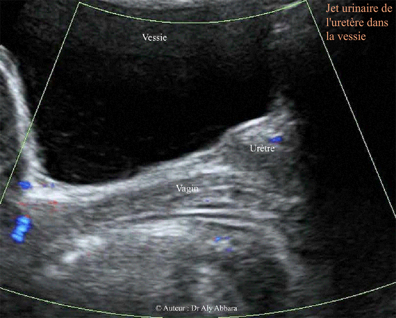 Jet urinaire intra-vésical
