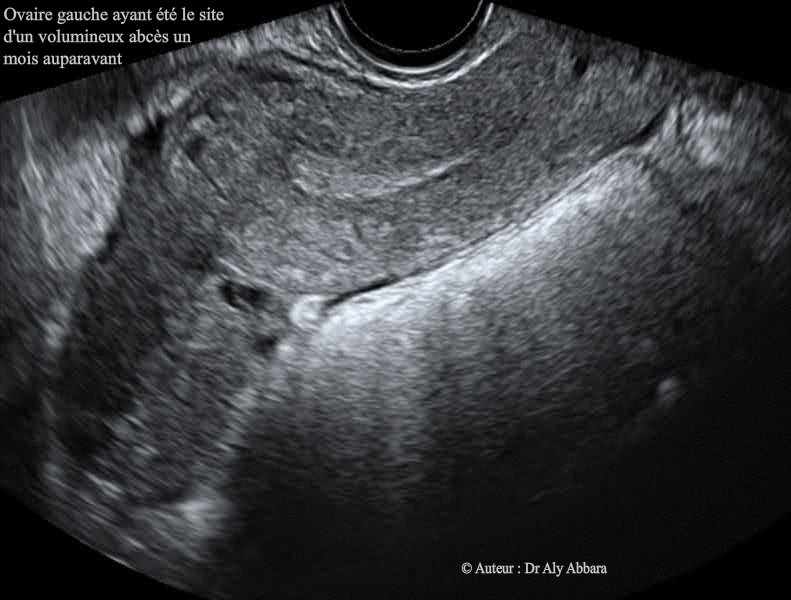 L'aspect de l'ovaire gauche qui était le site d'un abcès ovanrien un mois auparavant