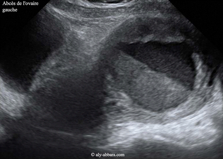 Images échographiques d'un abcès de l'ovaire gauche
