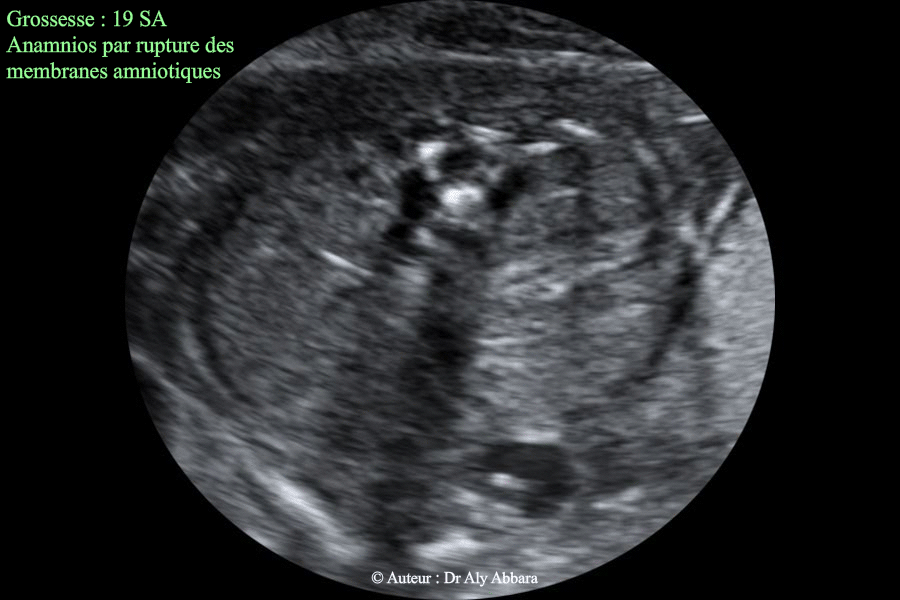 Anamnios en rapport avec une rupture prématurée des membranes à 19 SA - Reins identifiables