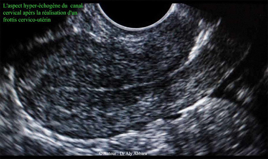 L'aspect hyper-échogène du canal cervical après la réalisation d'un frottis cervico-utérin par la rétention de particules d'air par la brosse