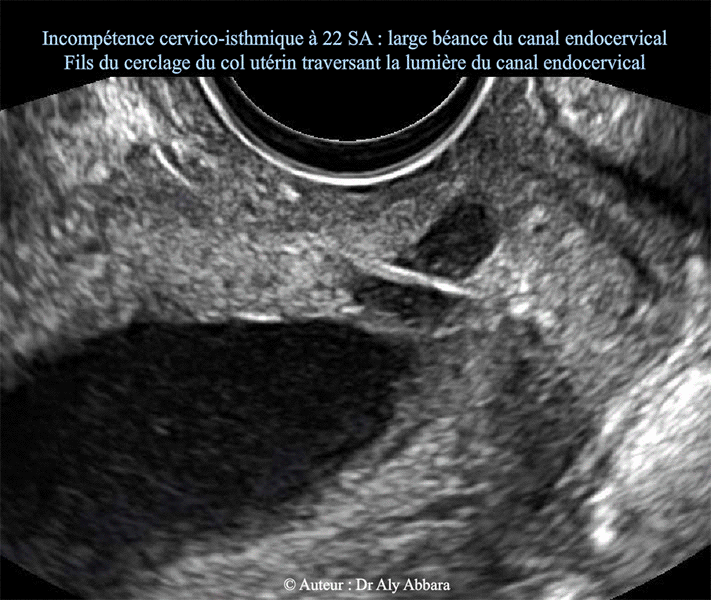 Incompétence de l'orifice interne du col utérin - grossesse de 22 SA