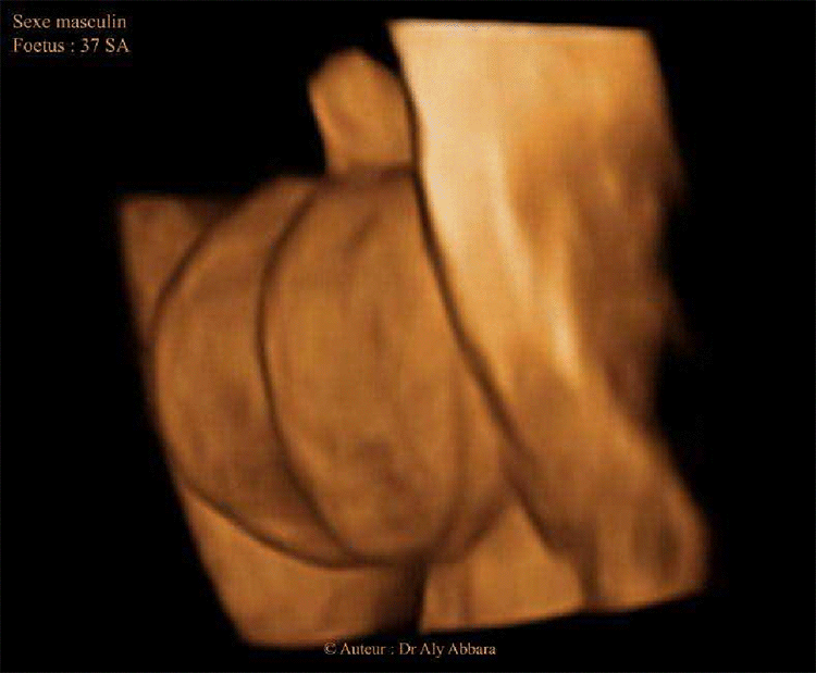 Organes génitaux externes chez un foetus du sexe masculin ; 37 SA