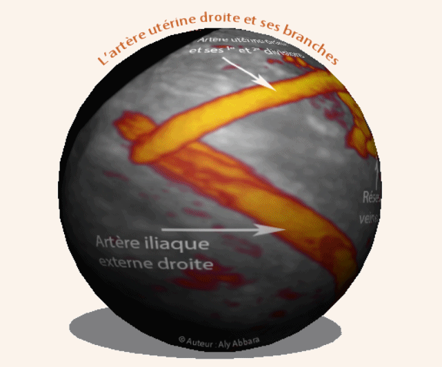 La planète - Artère utérine -L'artère utérine droite et ses branches